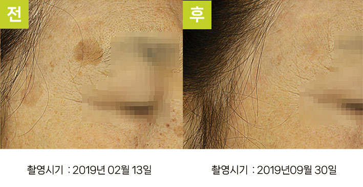 일광흑자 증례16 - 일광흑자+흑자증 전후