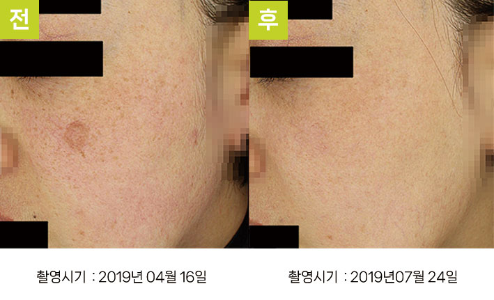 일광흑자 증례18 - 일광흑자+흑자증+눈가기미+홍조 전후