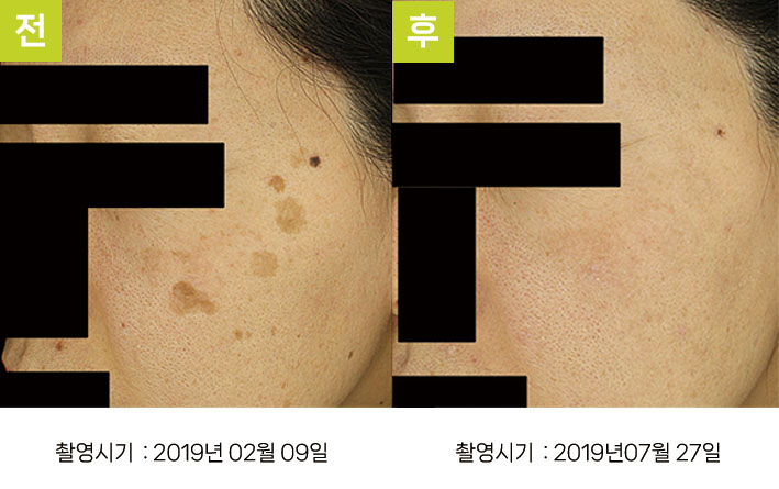 일광흑자 증례17 - 일광흑자+흑자증 전후