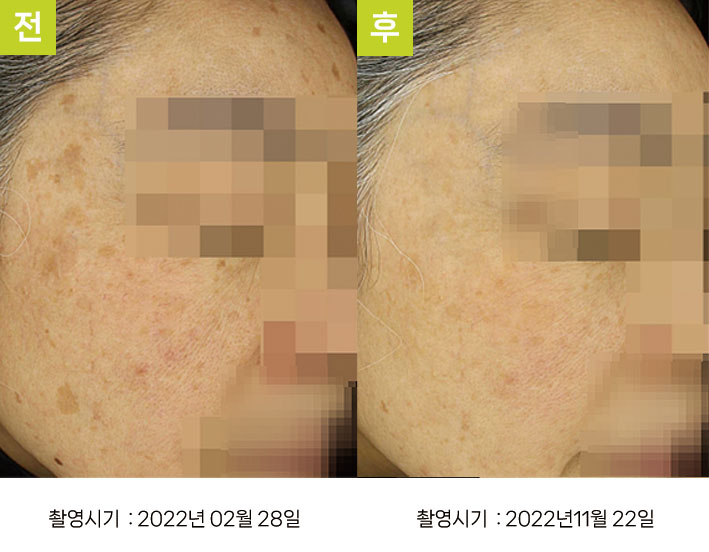 일광흑자 증례19 - 일광흑자+흑자증+눈가기미 전후