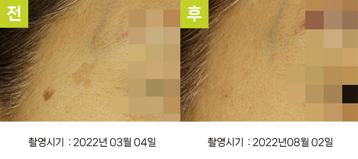 일광흑자 증례20 - 얼굴전반 일광흑자+흑자증 전후