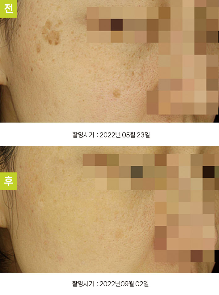 일광흑자 증례22 - 일광흑자+흑자증 전후