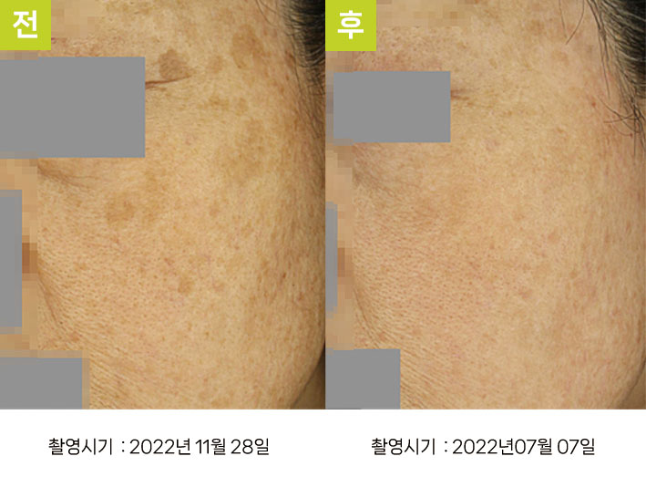 일광흑자 증례23 - 악화 후 오오집중색소치료프로그램 전후