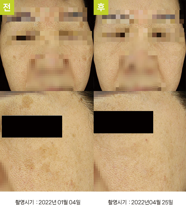 일광흑자 증례24 - 일광흑자+흑자증 전후