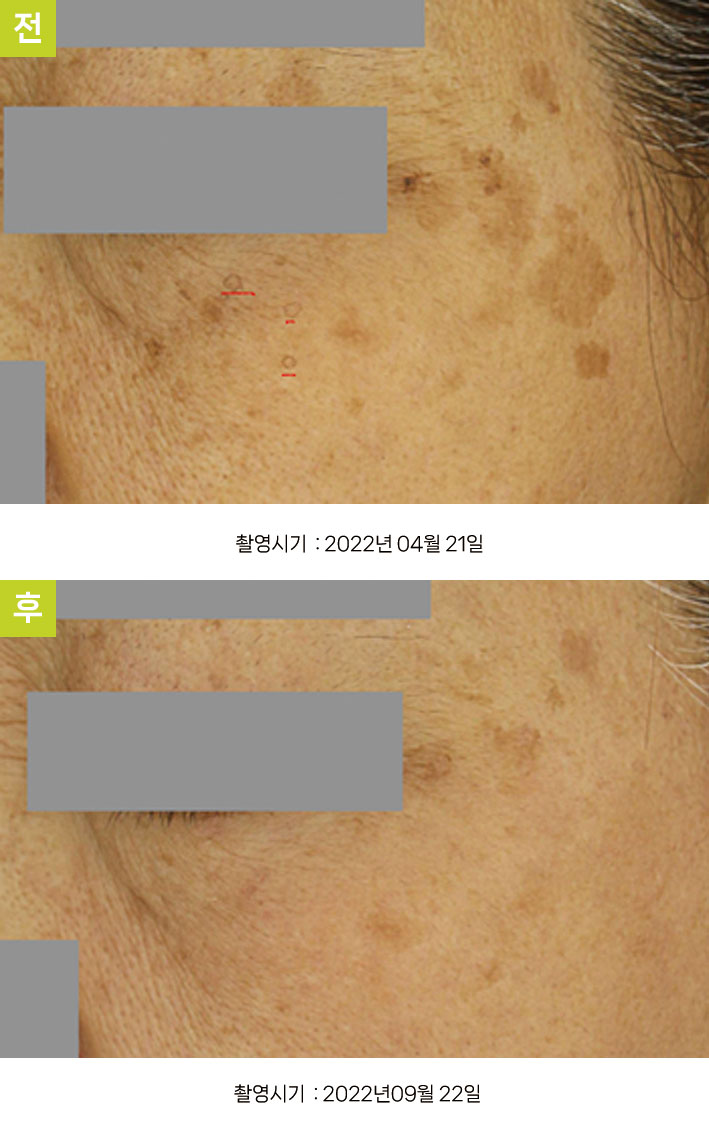 일광흑자 증례25 - 얼굴전반 흑자증+일광흑자+한공각화증 전후