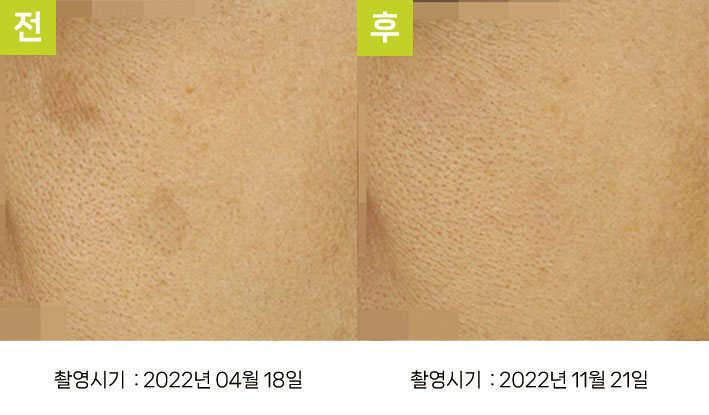 일광흑자 증례26 - 연한 일광흑자 전후