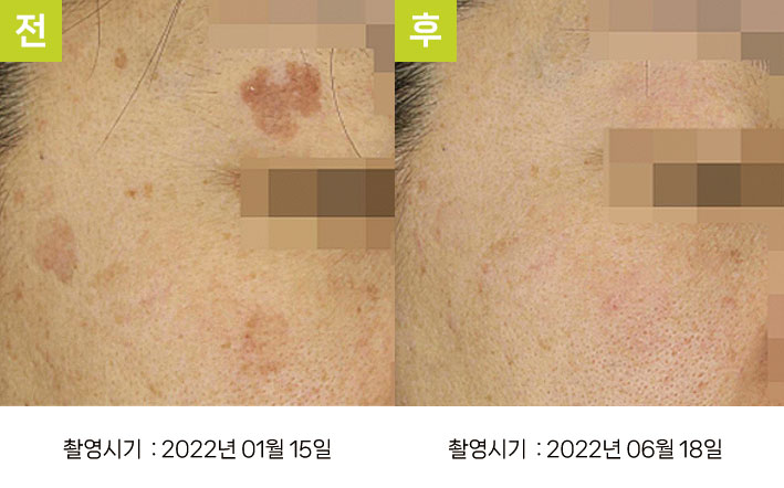 일광흑자 증례27 - 혈관 발달한 일광흑자 전후