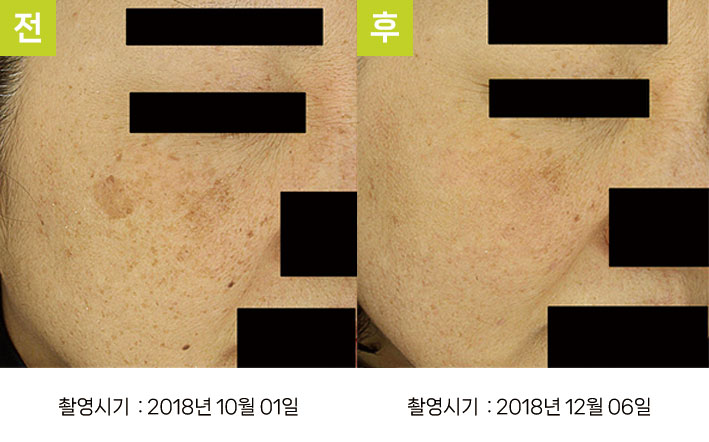 일광흑자 증례28 - 일광흑자+흑자증 전후