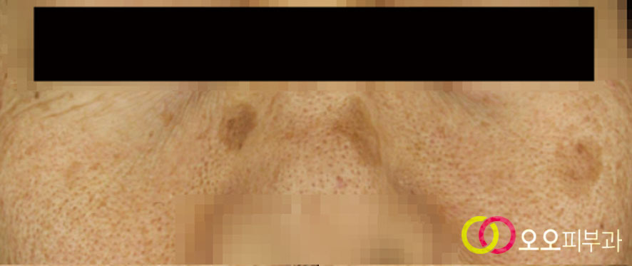 대구흑자제거 일광흑자 대표 이미지