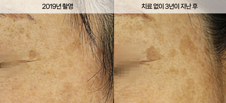 치료 없이 3년 후 더 넓고 진해진 흑자