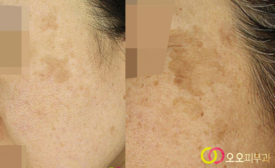 대구흑자치료 다양한 형태의 일광흑자
