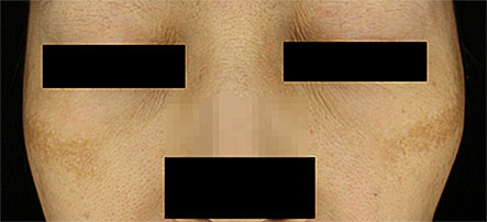 기미 예시 - 양뺨 대칭적으로 경계 불분명하게 번진 기미