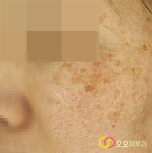 기미와 흑자가 동반된 어려운 색소 케이스