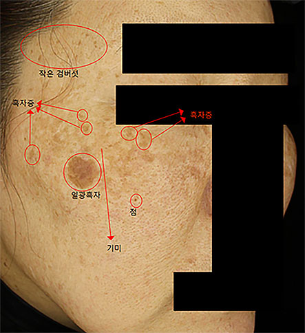 기미·흑자·검버섯이 혼재된 색소 병변 예시