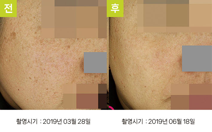 다발성흑자증 증례2 - 큰 일광흑자+양측성 다발성흑자증 전후