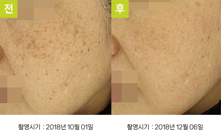 다발성흑자증 증례3 - 다발성흑자증+흑색구진성피부병 전후