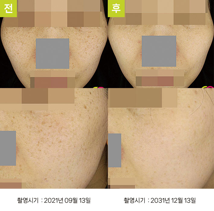 다발성흑자증 증례4 전후