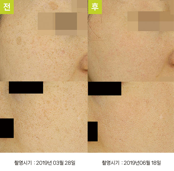 다발성흑자증 증례6 - 큰 일광흑자+양측성 다발성흑자증 전후
