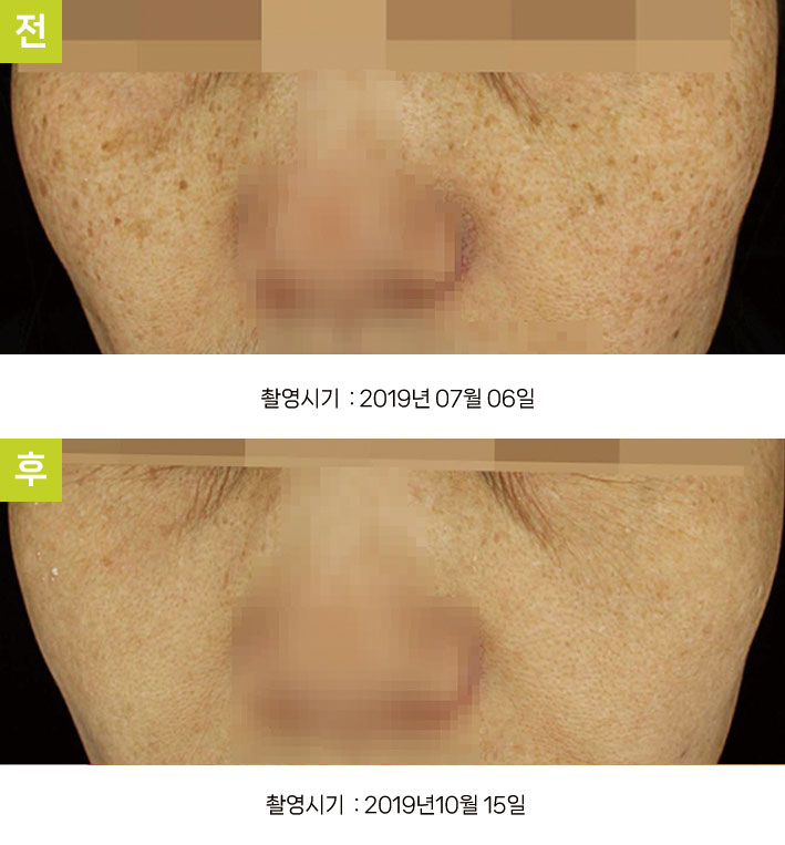 다발성흑자증 증례7 전후