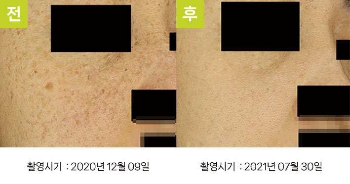 다발성흑자증 증례8 - 일광흑자+다발성흑자증 전후