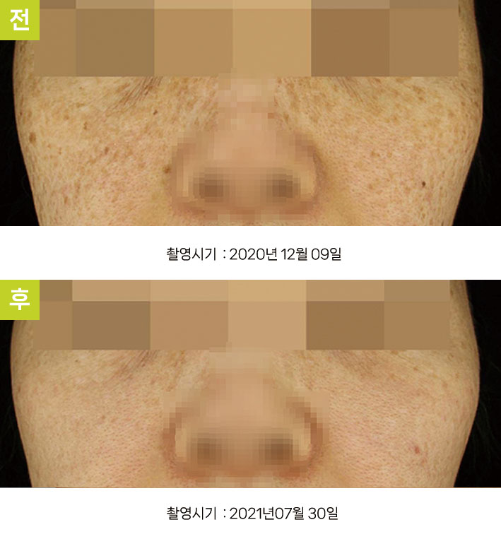다발성흑자증 증례8 - 일광흑자+다발성흑자증 전후