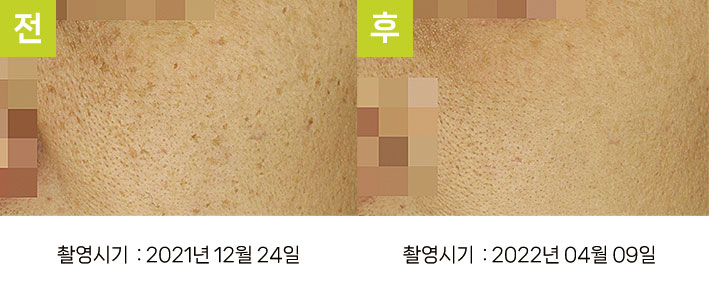 다발성흑자증 증례9 전후