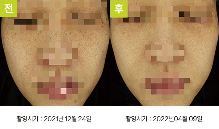 다발성흑자증 증례9 전후