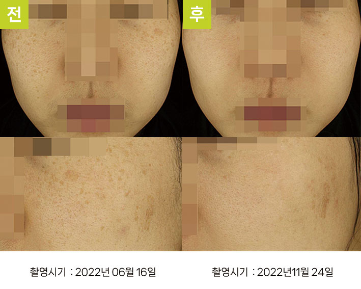 다발성흑자증 증례10 - 일광흑자+다발성흑자증+카페오레반점 전후