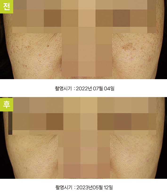 다발성흑자증 증례11 - 일광흑자+다발성흑자증 전후