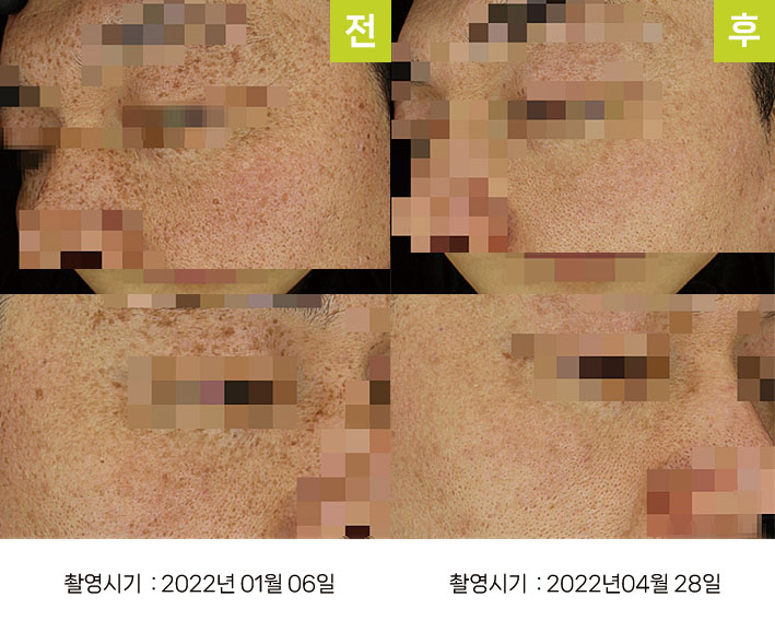 다발성흑자증 증례12 전후