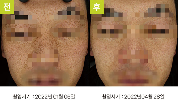 다발성흑자증 증례12 전후