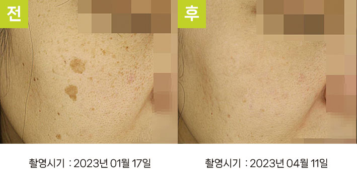 다발성흑자증 증례13 - 일광흑자+다발성흑자증 전후