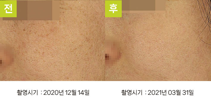 다발성흑자증 증례14 전후