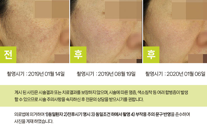 선천성 오타모반 시술 전 (2019년 1월)