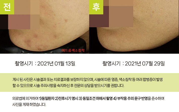턱 여드름 색소침착 시술 후
