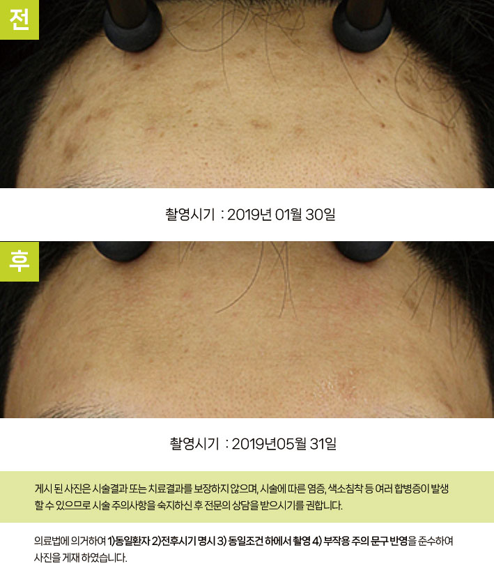 이마 여드름 색소침착 시술 후