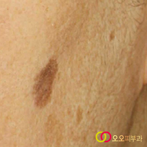 일광흑자 병변 클로즈업