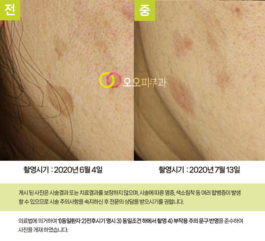 일광흑자 병변 클로즈업