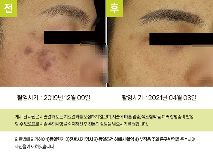 반복적인 자극으로 형성된 진피형 색소침착과 기미 동반