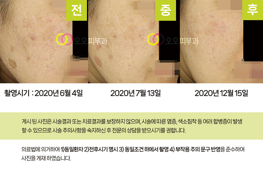 색소침착 치료 전