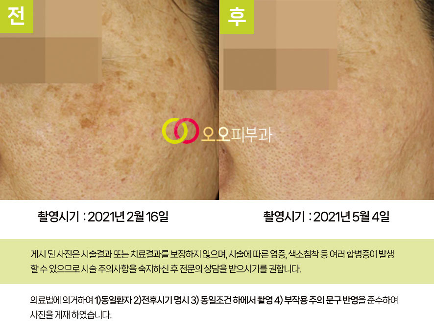 색소침착 치료 전