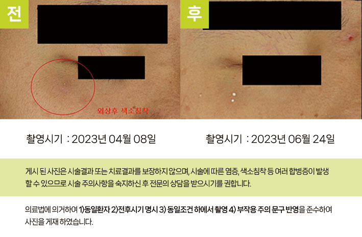 외상 후 색소침착 호전
