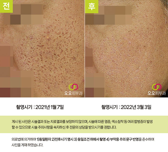 복합 치료 전