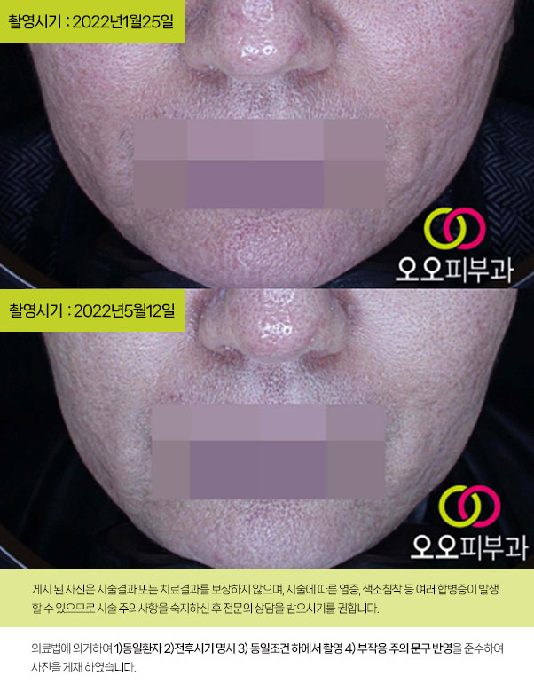 복합 치료 전