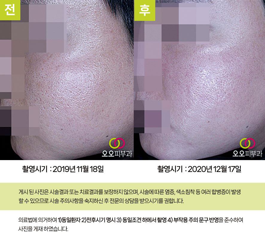 크로스요법 시술 전후