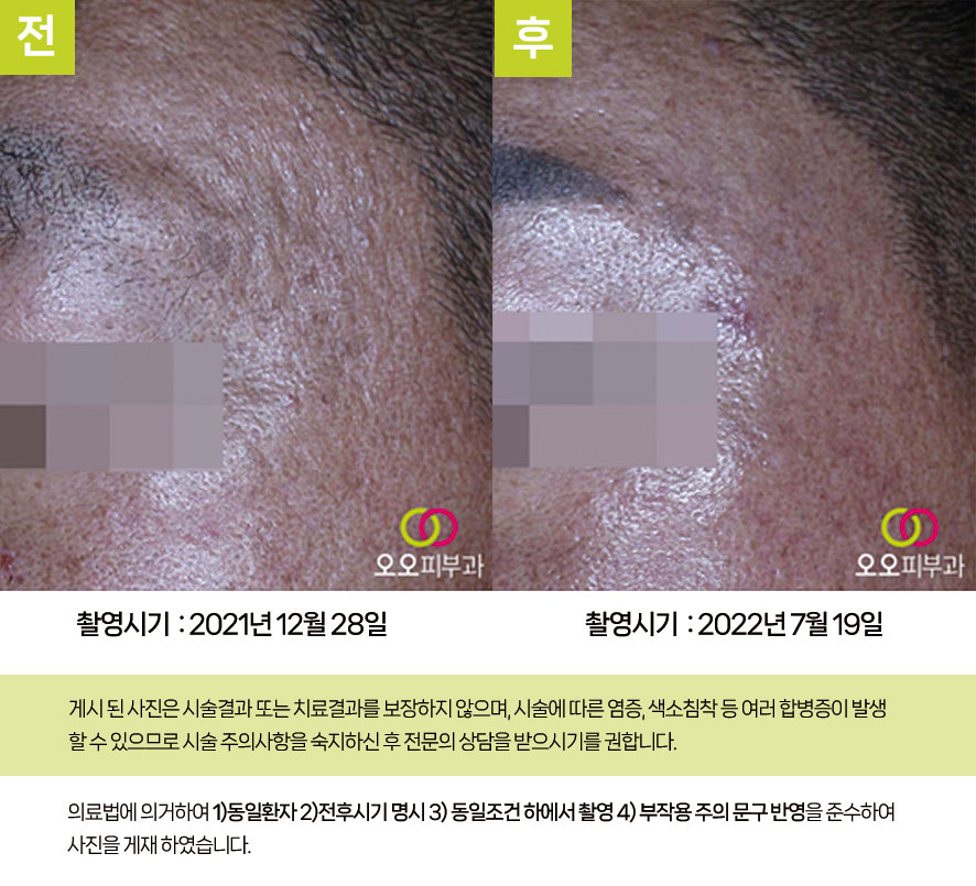서브시전·필러 시술 전후